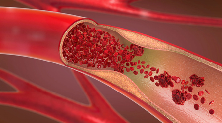 Атеросклероз - следствие клеточного старения = сенесцента, а не сенелита = старения организма
