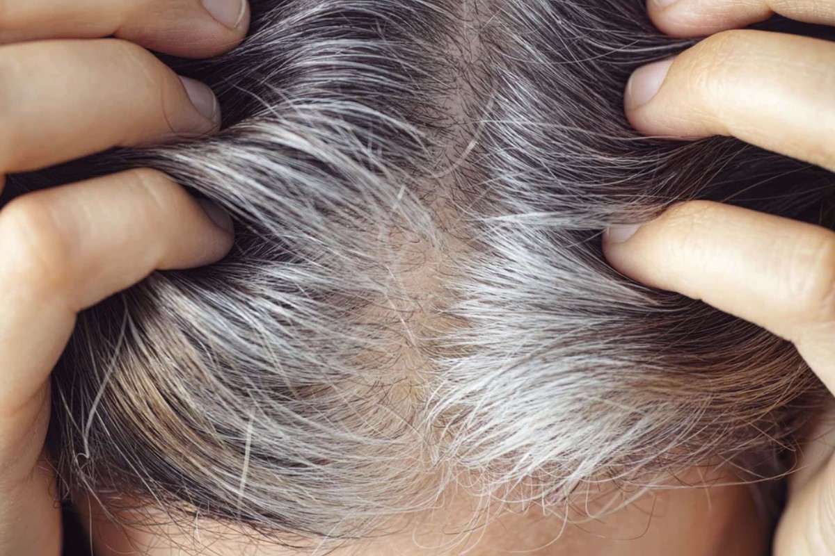 Поседение волос — не только наглядный маркер старения на клеточном уровне = сенесцент, но и модель для понимания его механизма и причин