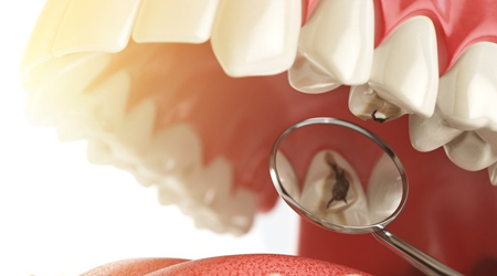 Способ лечения и профилактики с гарантией зубного кариеса и зубной боли